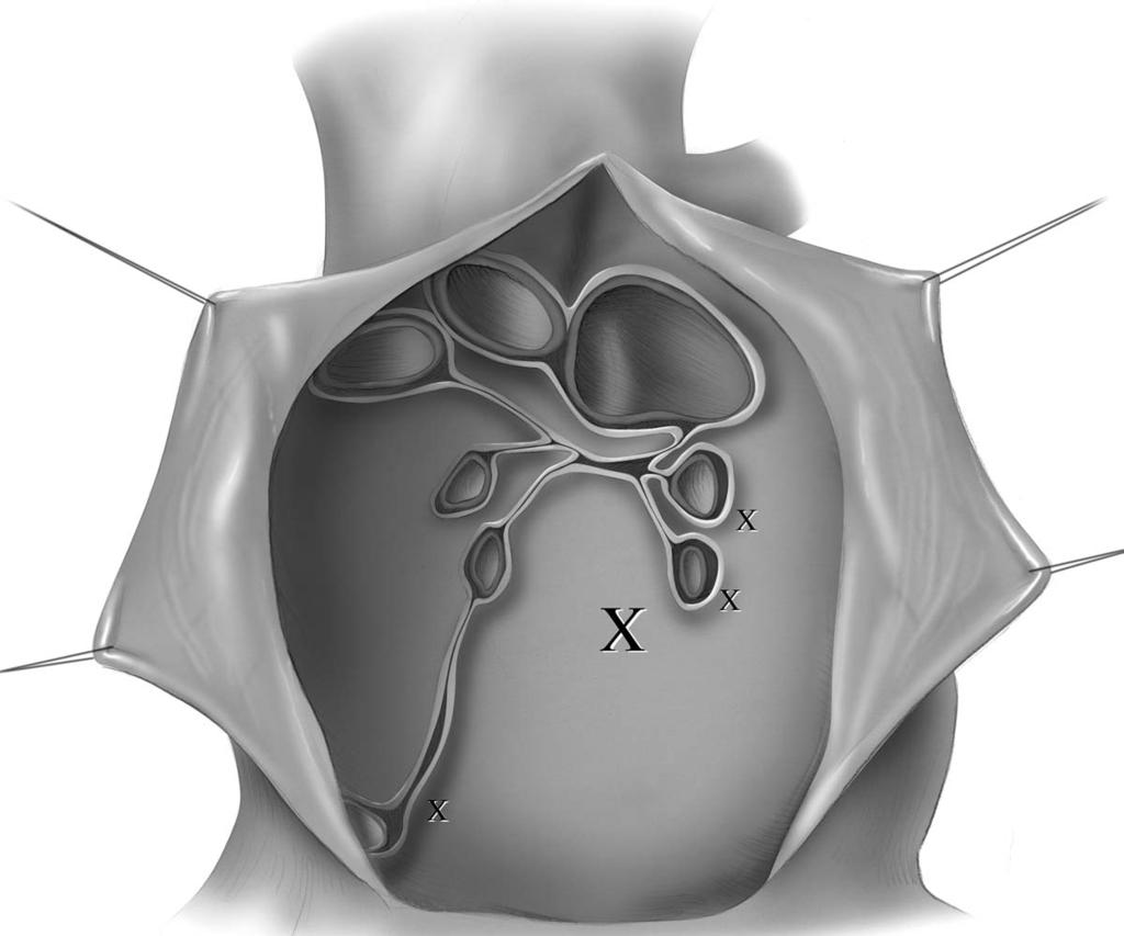 82 J.D. Puskas Figure 4 The two most common patterns of deep pericardial sutures are the single-stitch and the four-stitch techniques.