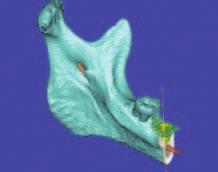 Using the postoperative CBCT images,