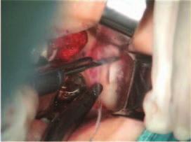 Simulation of sinus graft The mandibular bone harvesting on the anterior