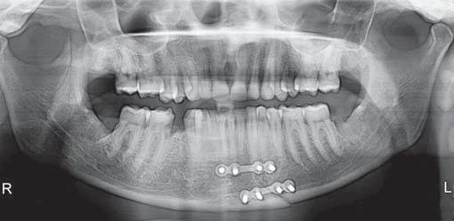 Complication related to open reduction and internal fixation is the highest reported in the maxillofacial literature.