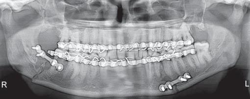 The third molar in the line of fracture should be preferably removed prior to fixation. The authors do not find any possible advantage of preserving it.