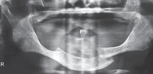 typical common fracture in this group of patients is a bilateral body fracture or bucket-handle fracture (Figs 4 and ).