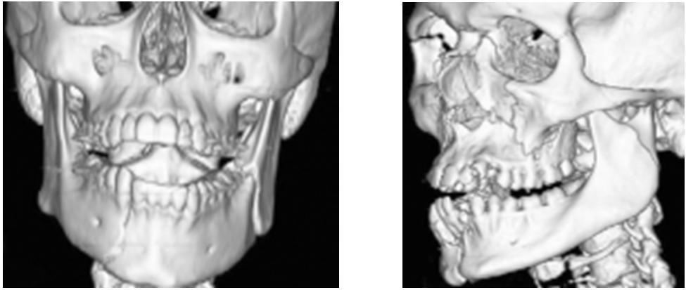 Impacted molar in the line of fixation 2.Malocclusion 01 with IMF 3. Marginal mandibular nerve paraesis 03 The following post operative complications noted in 8 patients.these include 1.