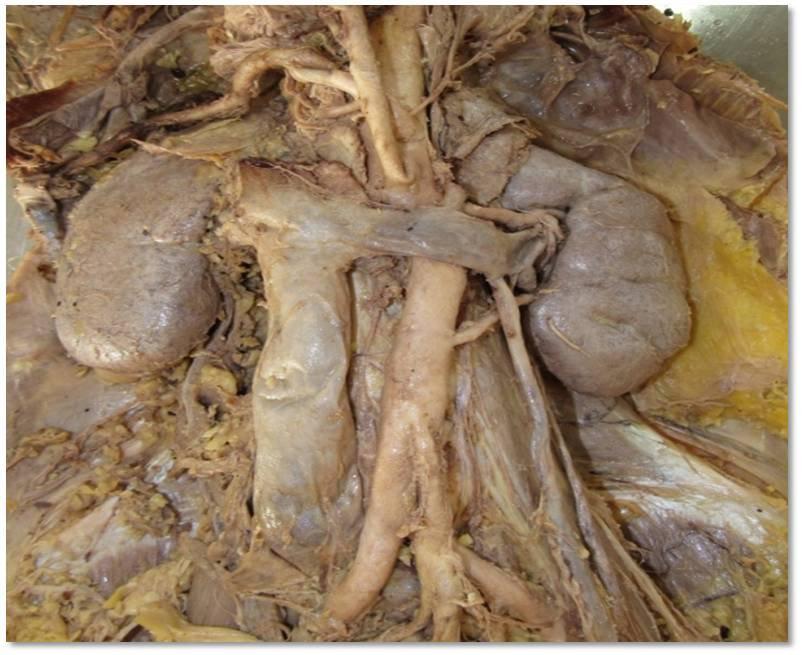 the artery for the lower pole usually passes behind the pelvis of ureter, causes obstruction to the flow of urine producing hydronephrosis 1 It is important to be aware that accessory renal arteries
