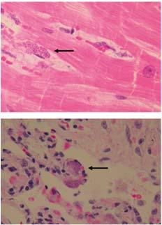 Screening recommendations Chagas Risk-stratified screening in donors and heart recipients with a history of Chagas Post-transplant PCR monitoring immediately following