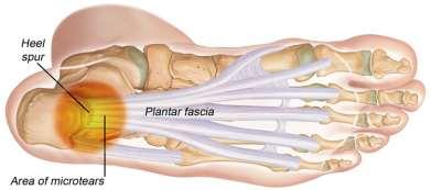 As one of the most common heel injury, plantar fasciitis would be painful injury to individual. This injury usually take a long period to get worsen.