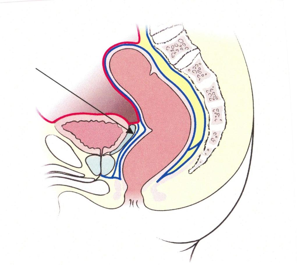 TME Dissection plane Denonvilliers fascia = Rectogenital fascia Rectal proper fascia = Fascia propria of the rectum