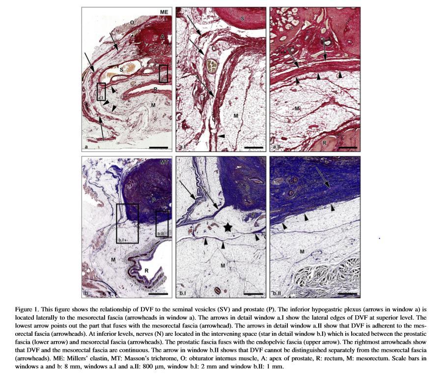Denonvilliers fascia is one entity and adherent to the mesorectal fascia: implication for the anterior plane in TME? Kraima AC et al.