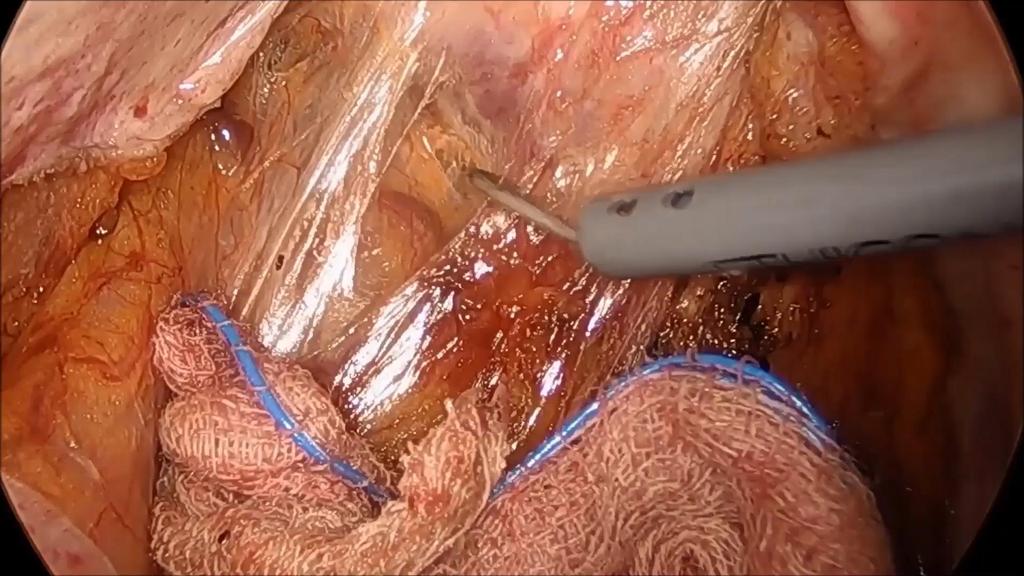 Anterolateral pelvic