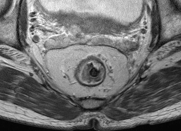 Mesorectal fascia on MRI :