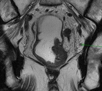 Pelvic floor images on MRI coronal axial view A.
