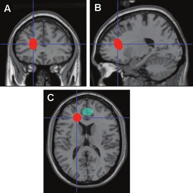 52 Fowler and Griffiths highlights that the location of lesions which were clinically demonstrated to have long-term effects on bladder function was in white matter tracts (connecting pathways