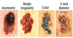 lesions for every melanoma removed in the