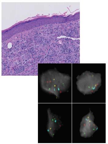 MelanoSITE FISH probe panel Malignant melanoma FISH pattern: multiple copies of RREB1 (red
