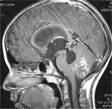 Medulloblastoma Most frequent malignant brain tumor of childhood age: 0-40 J, peak at 7 years Localization: Cerebellum Anamnesis: short Symptoms: