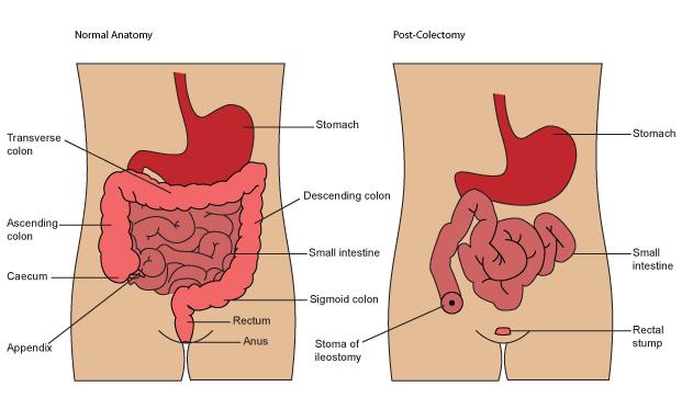 Total Colectomy with End Ileostomy Removal of the entire colon Emergency surgery or elective Crohn s disease and