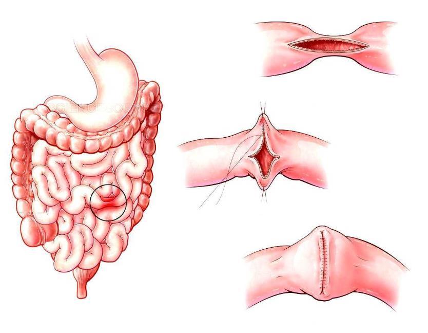 Strictureplasty For Crohn s