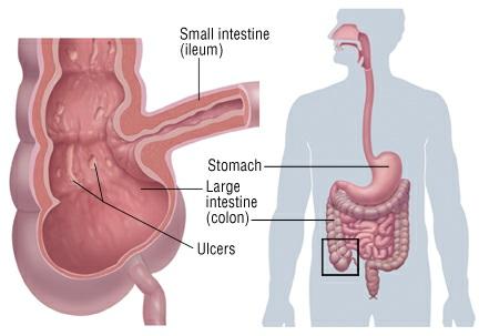 Symptoms Some people with Crohn's disease have only occasional cramps, or diarrhea. Their symptoms are so mild they do not seek medical attention.