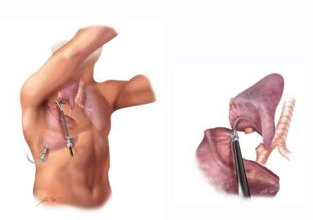 Minimally Invasive Lung Resection AKA: