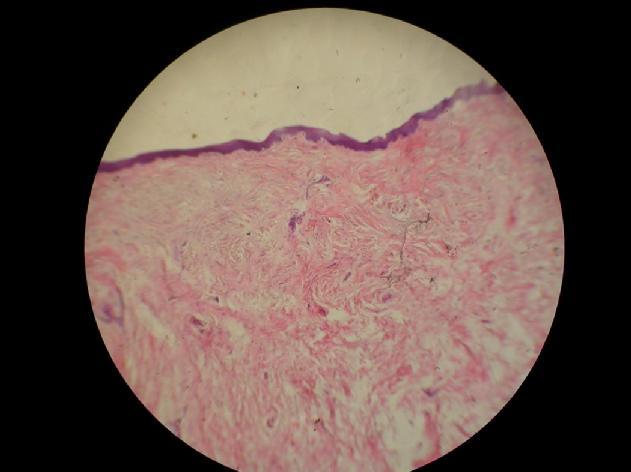 Figure 7a,7b Collagen fibers interspersed with varying number of fibroblasts [10X,40 X] DISCUSSION Oral verrucous hyperplasia is a precancerous lesion that can lead to two important lesions such as