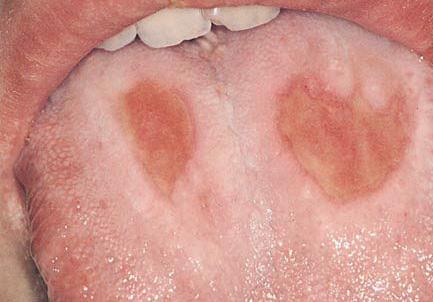 Figure : Tongue ulceration Figure 4: Fissure Regarding the location of lesions on surfaces, out of 3 subjects, 53 subjects