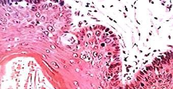 of cervical cancer deaths in US, and most experts feel that this decline is due to the widespread use of the cervical pap smear, given the similarity in mucosal pathology between the oral cavity and