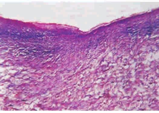 Inflammatory infiltrate in Lichen Planus.