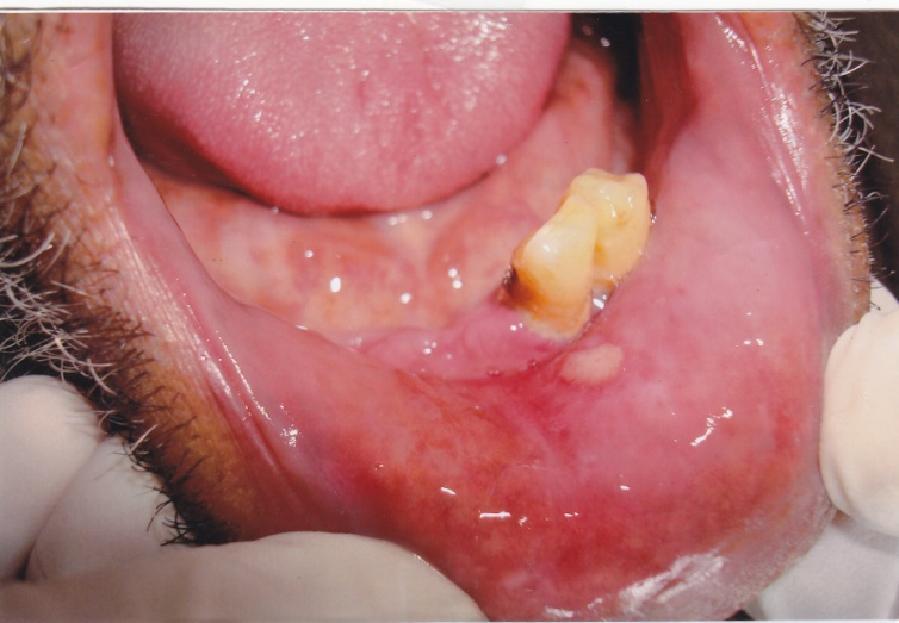 The lesions are more prevalent in adults (1%-4% of cases) than in children. Oral warts may appear cauliflower-like, spiked, or raised with a flat surface. They are asymptomatic.