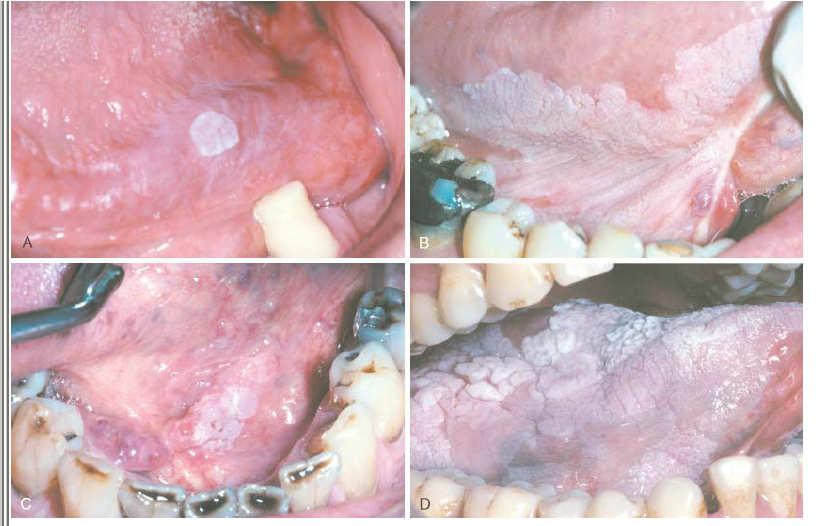 Leukoplakia wide variation White patch or plaque that cannot be
