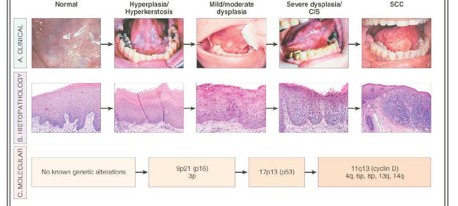 Progression of Oral Carcinoma