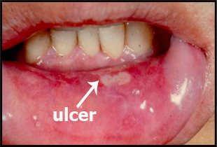 Aphthous Ulcers Very common Painful and recurrent.
