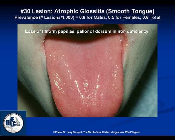 Glossitis Referred to beefy red tongue seen in deficiency states.
