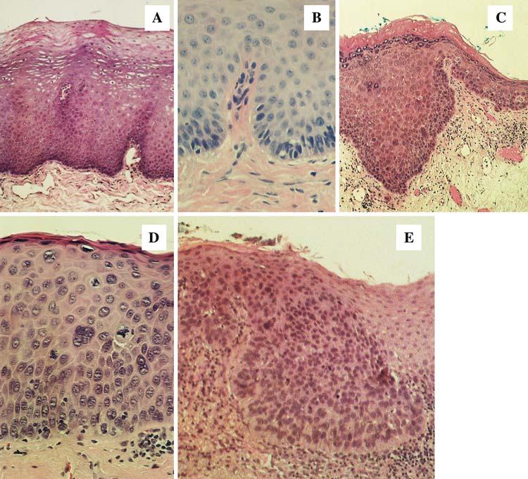 64 Head and Neck Pathol (2009) 3:63 68 Fig. 1 The WHO grading system for oral and laryngeal precancerous lesions. a. Benign hyperplasia (benign keratosis), b. mild dysplasia, c. moderate dysplasia, d.