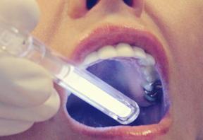 SCREENING AIDS Chemiluminescence q Chemiluminescent blue/white light has been used for oral screening q ViziLite involves the use of an oral rinse with a 1% ace,c acid solu,on for 1 minute followed