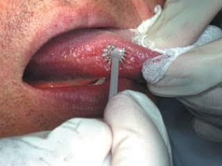 SCREENING AIDS Brush biopsy q The oral brush biopsy (OralCDx Brush Test system) is a method of collec,ng a transepithelial sample of cells from a mucosal lesion with representa,on of the superficial,