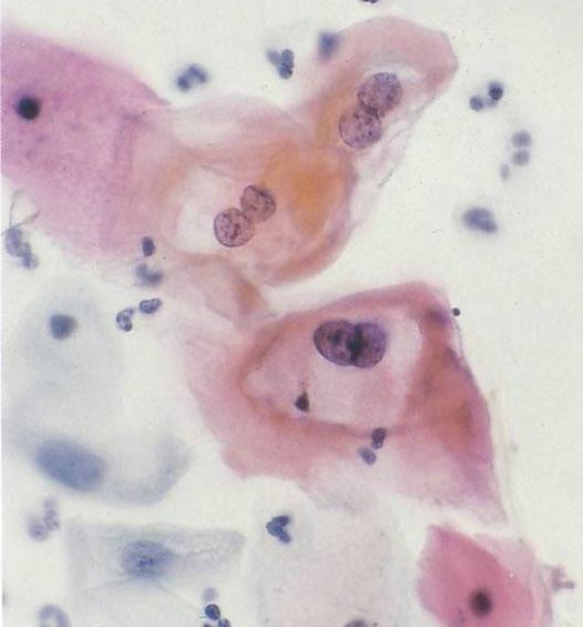 positive; probable normal variant d. positive; compatible with high grade lesion Question 2 The cytology shows: a.