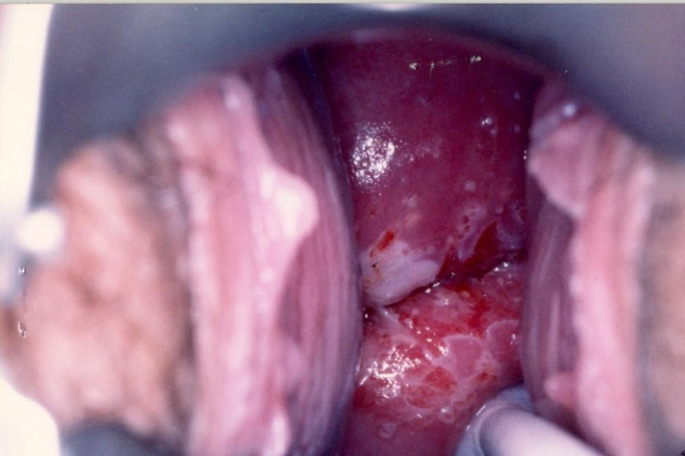 14 months after initial enrollment, the image of her cervix is shown (Figure ). HPV DNA is positive for HR types. Question 1 Colposcopic findings seen include: a.