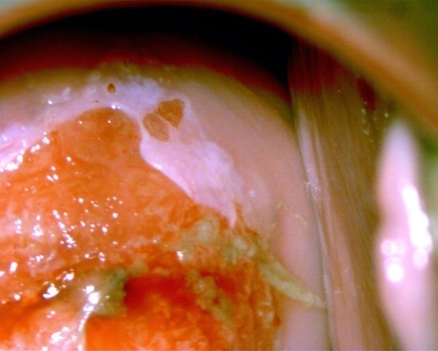 The patient underwent a colposcopic examination with a biopsy.
