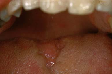 Median Rhomboid Glossitis Midline dorsum of tongue Aetiolgy