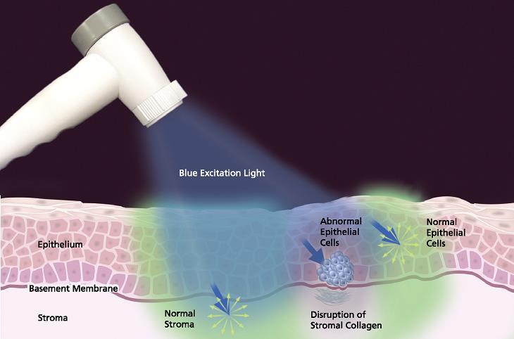 Tissue Fluorescence and Dysplastic Progression Breakdown of Collagen Matrix (prelude to invasion) Collagen cross-links Fluorescence Metabolic Activity FAD Fluorescence