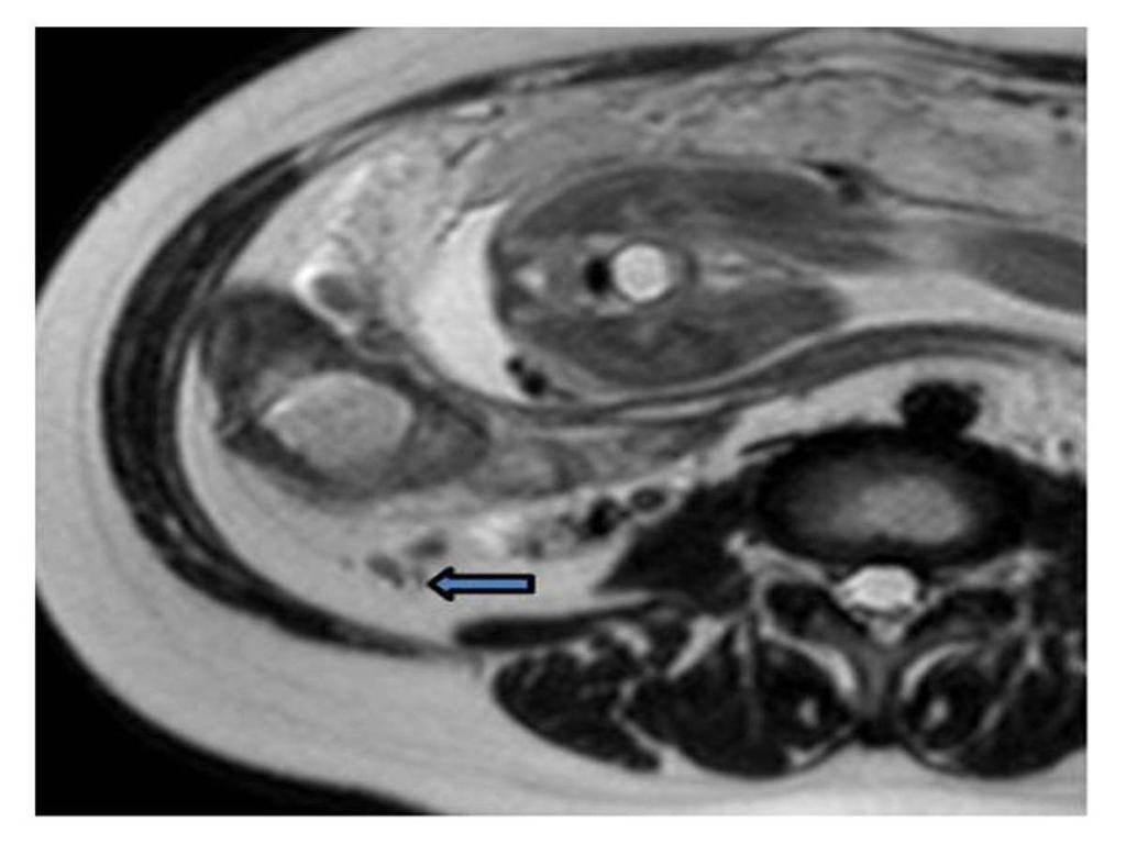 Fig. 10: A 37-year-old pregnant woman was diagnosed with fetal hydrocephalus and the normal ascending retrocecal appendix on MR images.