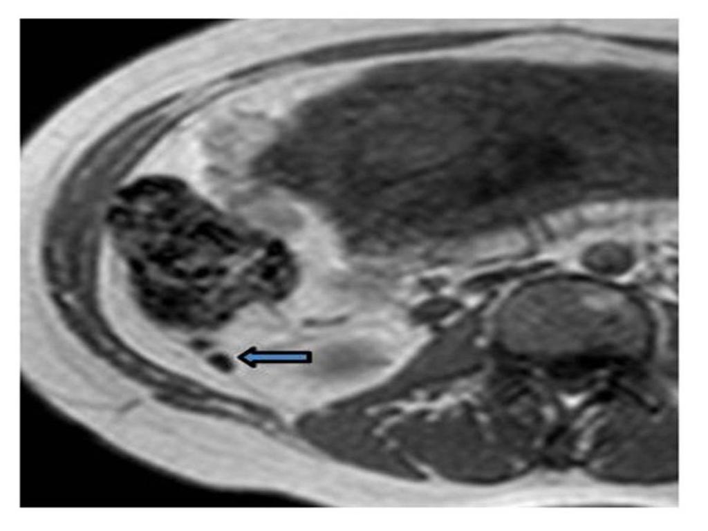 Fig. 12: A 37-year-old pregnant woman was diagnosed with fetal hydrocephalus and the normal ascending retrocecal appendix on MR images.