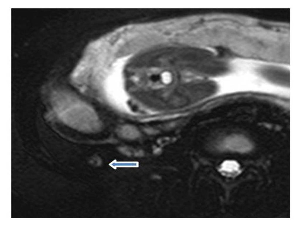 Fig. 14: A 37-year-old pregnant woman was diagnosed with fetal hydrocephalus and the normal ascending retrocecal appendix on MR images.