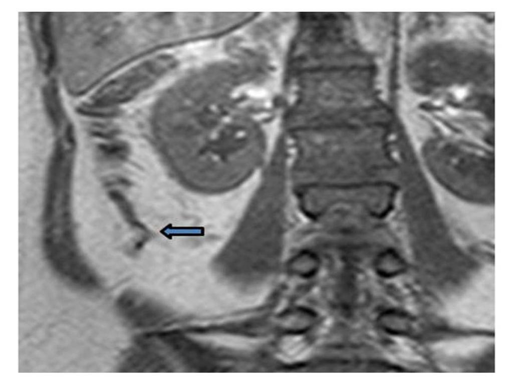 Fig. 15: A 37-year-old pregnant woman was diagnosed with fetal hydrocephalus and the normal ascending retrocecal appendix on MR images.