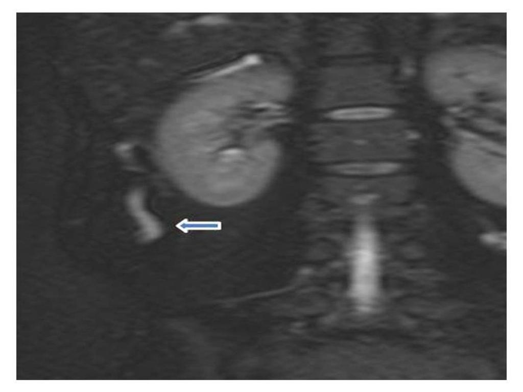 Fig. 17: A 37-year-old pregnant woman was diagnosed with fetal hydrocephalus and the normal ascending retrocecal appendix on MR images.