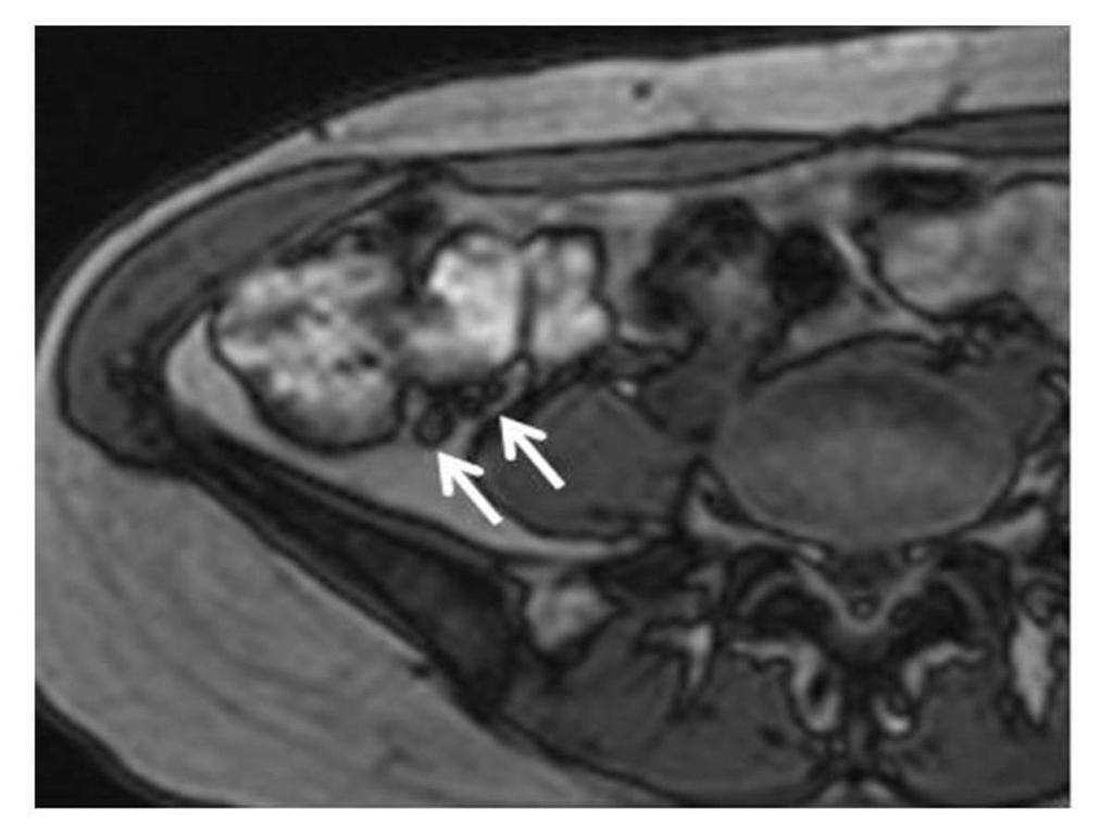 Fig. 3: A 35-year-old pregnant woman was diagnosed with endometriosis in right ovary.