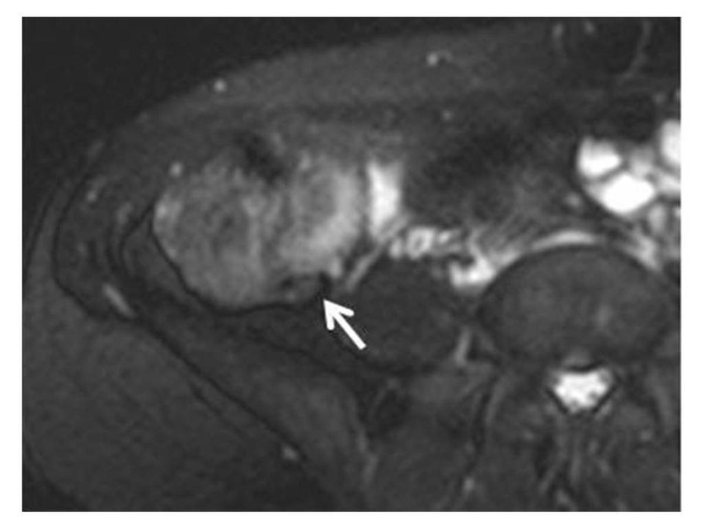 Fig. 5: A 35-year-old pregnant woman was diagnosed with endometriosis in right ovary.