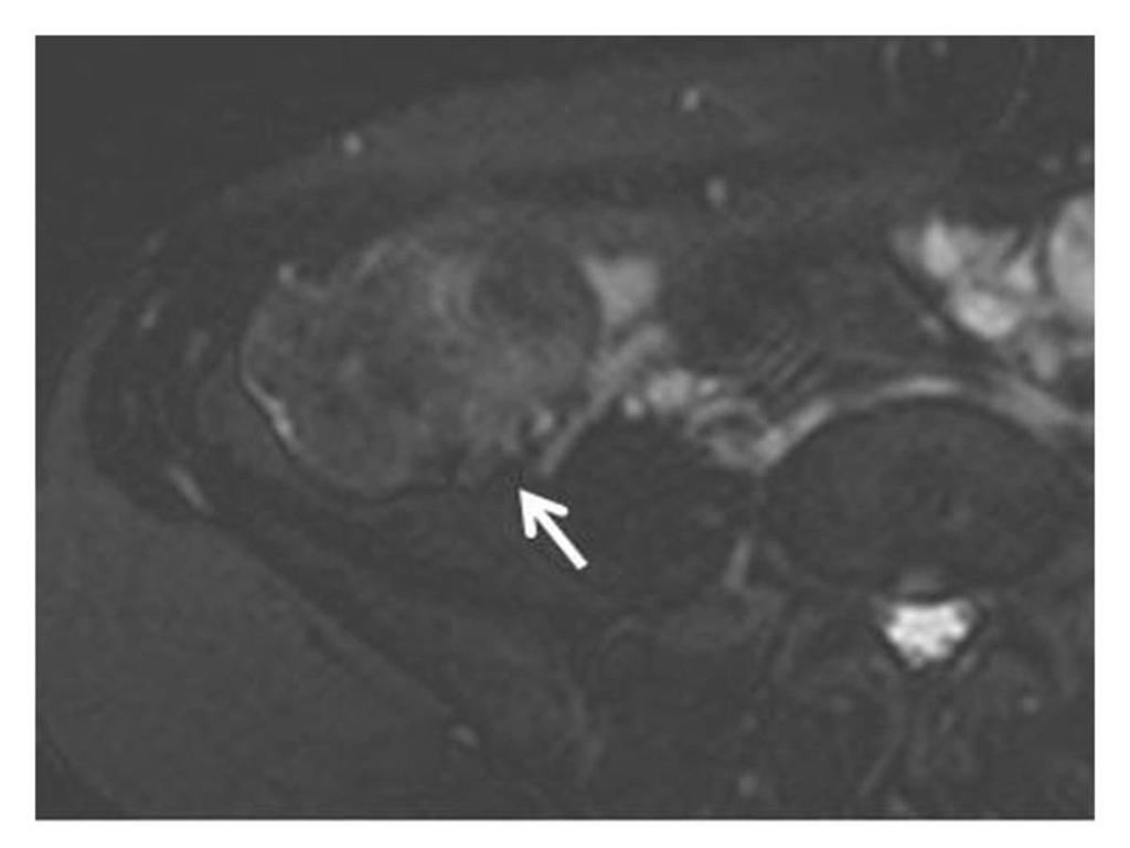 Fig. 6: A 35-year-old pregnant woman was diagnosed with endometriosis in right ovary.