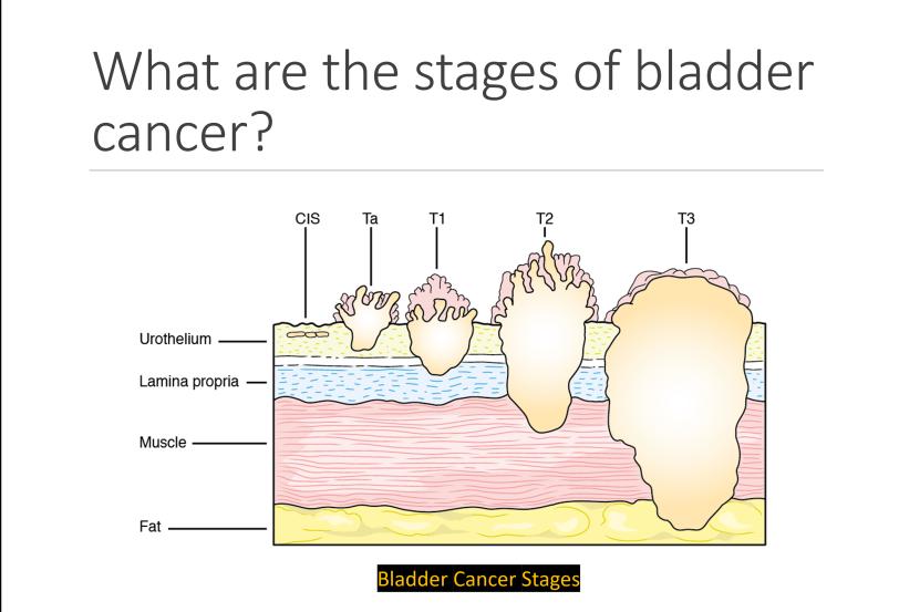 with fat. So what is bladder cancer, then? So bladder cancer is when the cells in the wall of the bladder, usually they start in the inner most layer, they start to grow sort of out of control.