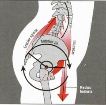 Anterior Tilt ASIS is tipped forward of the Pubic